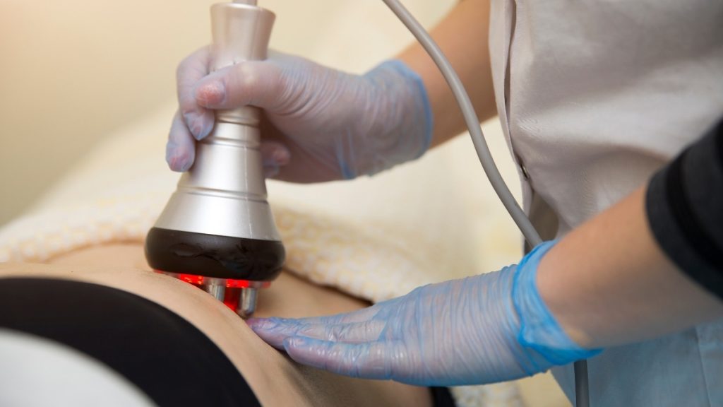 ラジオ波療法（RF）でセルライトを除去